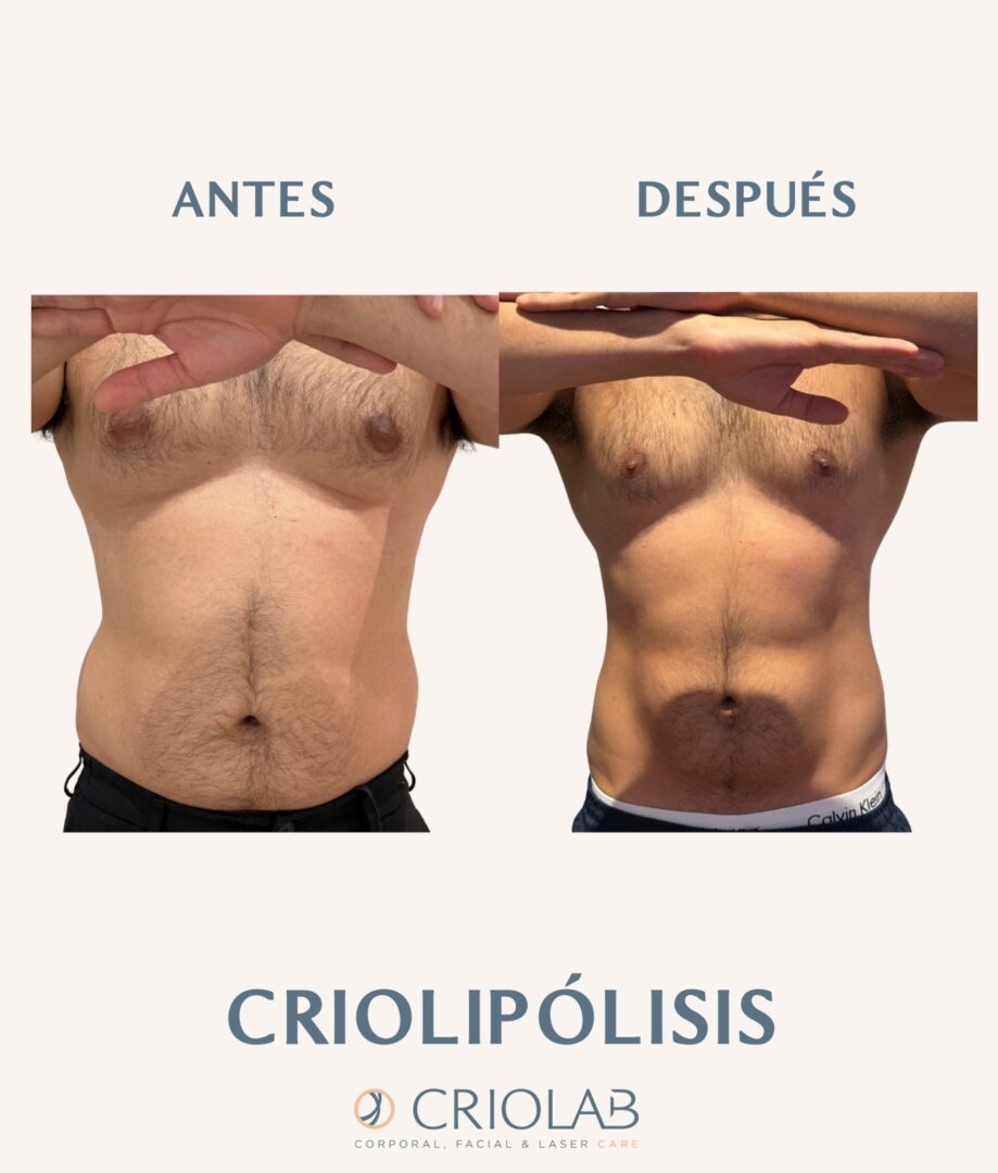 Criolipólisis con CoolTech Define