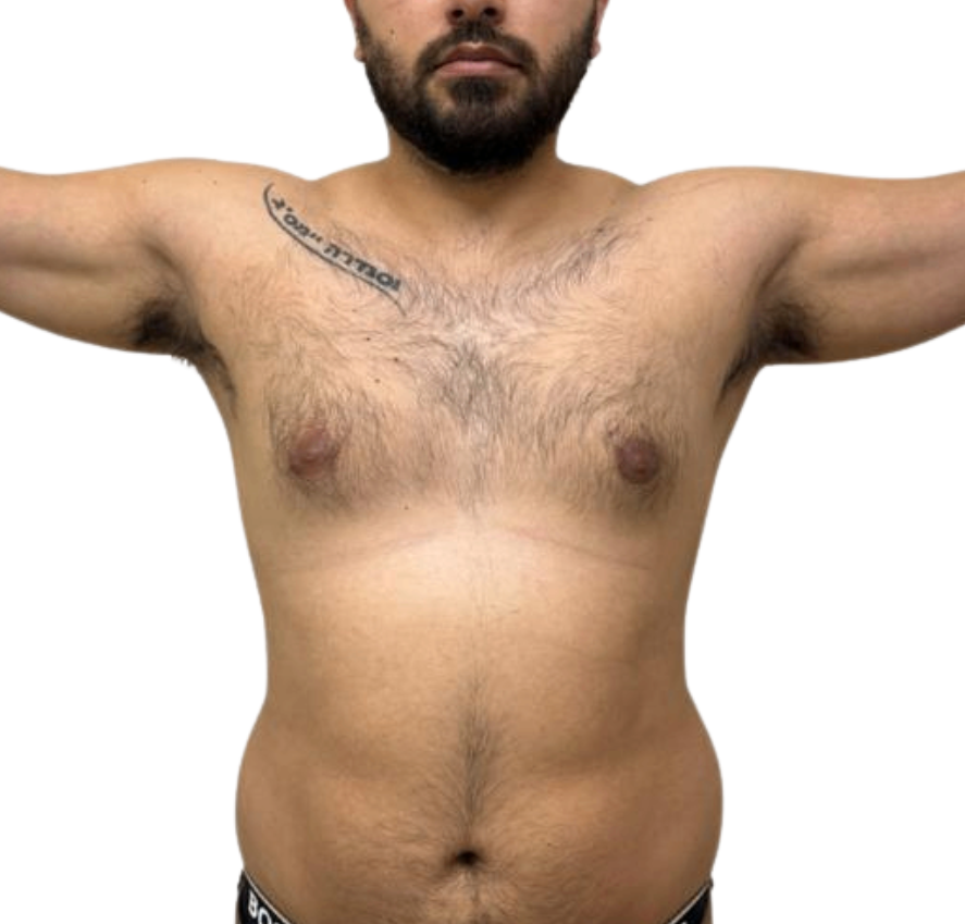 Antes del tratamiento de moldeamiento corporal CrioGold en Criolab — zona abdominal y flancos