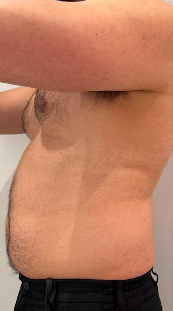 Antes_Criolipolisis_360_Criolab