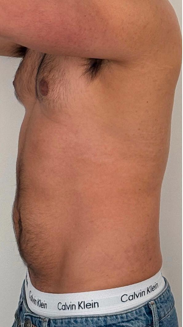 Despues_Criolipolisis_360_Criolab
