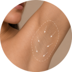 Hiperhidrosis